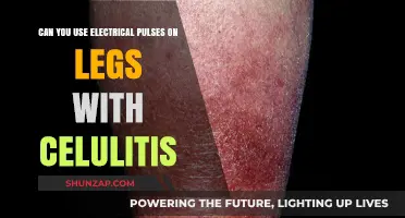 Electrical Pulses for Leg Cellulitis: Safe and Effective Treatment Option?