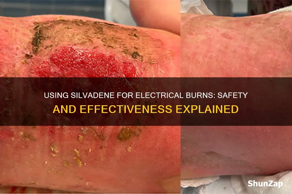 can you use silvadene on electrical burn
