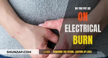 Electrical Burns and Ice: What You Need to Know