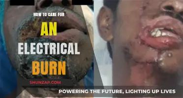Healing Electrical Burns: Essential Care Tips for Quick Recovery
