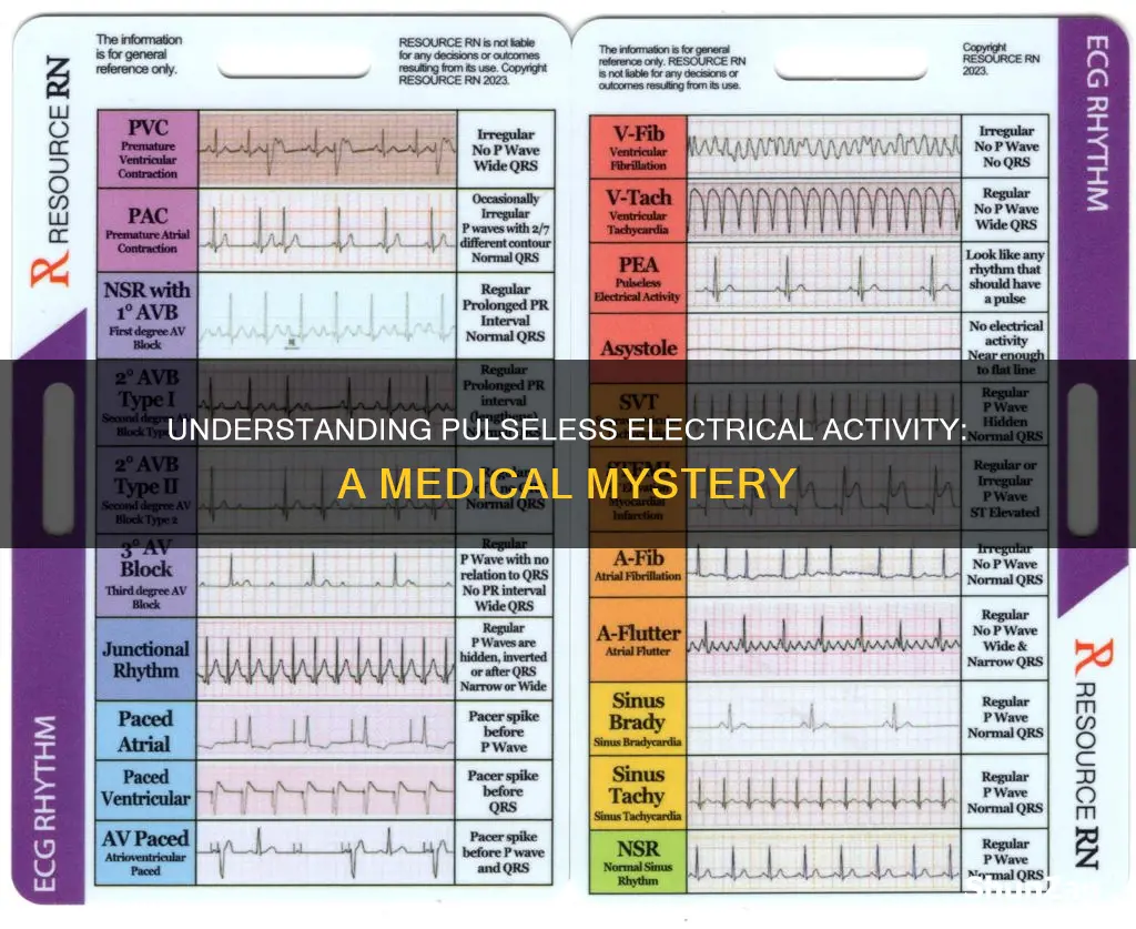 what does pulseless electrical activity look like