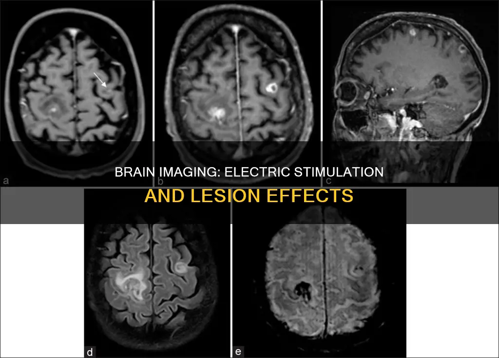 what is lesion brain imaging electric stimulation