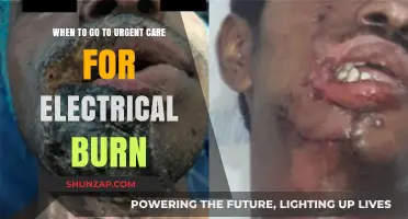 Electrical Burns: When to Seek Urgent Care Treatment