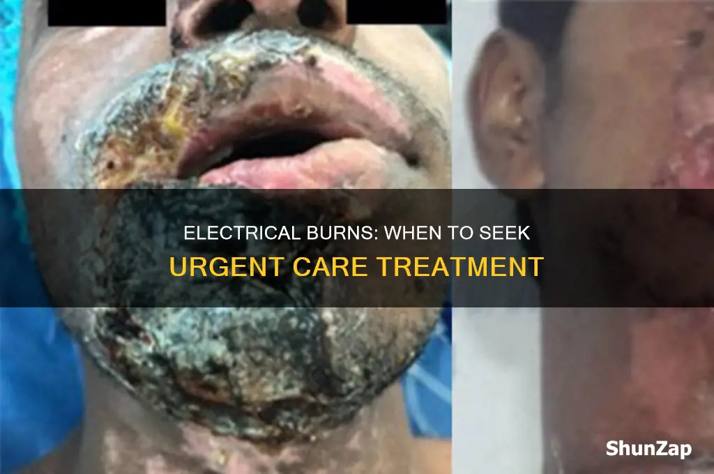 when to go to urgent care for electrical burn
