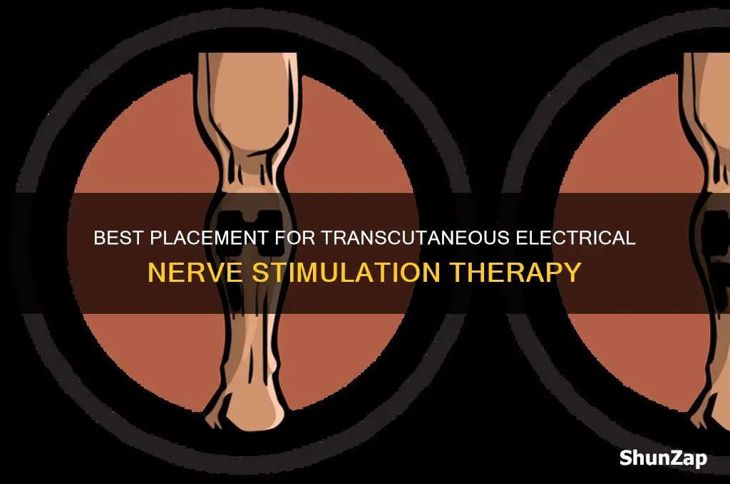 where to place transcutaneous electrical nerve stimulation
