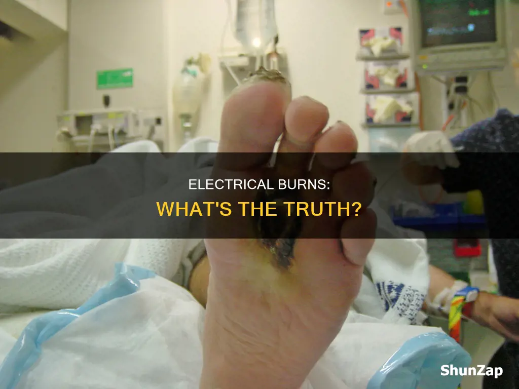 which statement about electrical burns is true