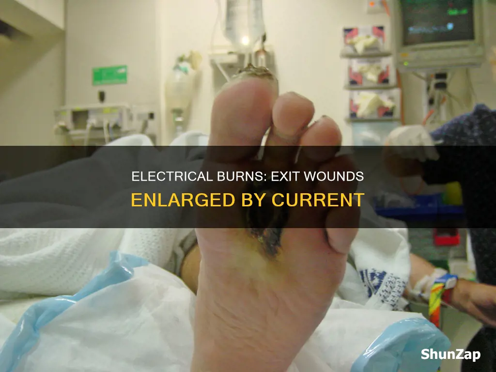 why are electrical burn exit wounds larger